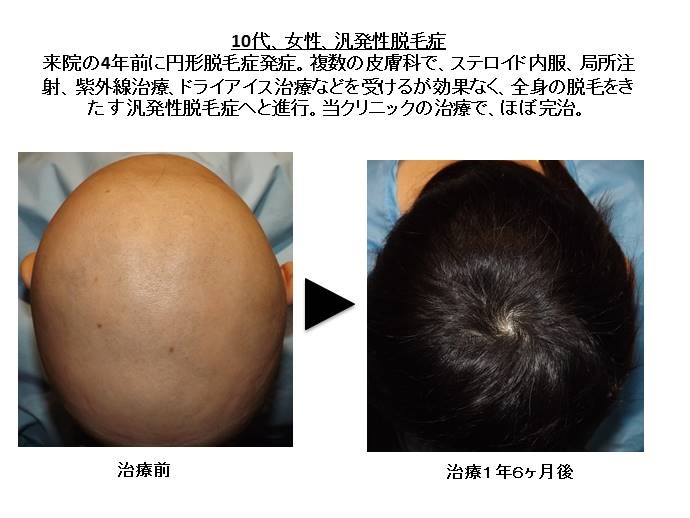円形脱毛症　名医""